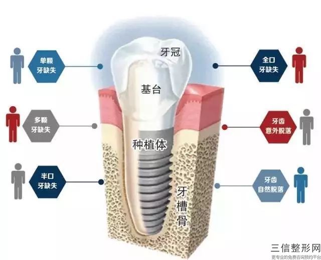 12顆全瓷牙要多少錢，你知道嗎？