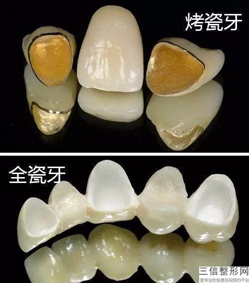 做種植牙多少錢一顆？價格與患者選擇的醫院有關