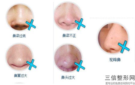 做隆鼻失敗修復手術需要多少錢？有了一定的了解