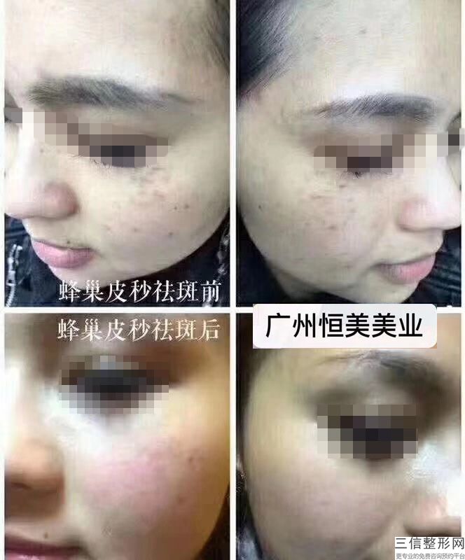 皮秒激光多少錢一次皮膚護理影響到價格在術后需要做好