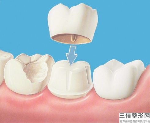 全瓷牙到底好在哪里？金屬烤瓷牙需要多少錢