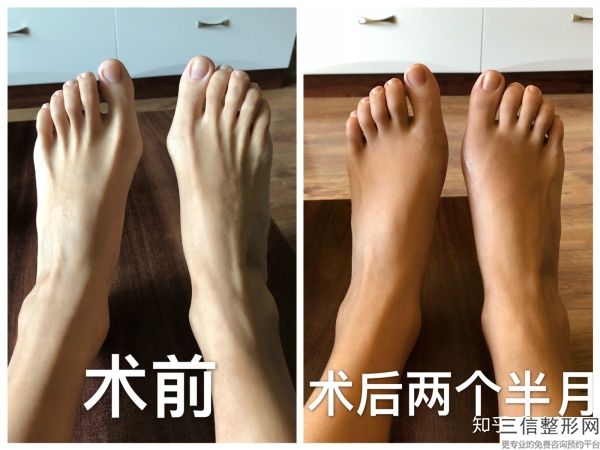 合肥吸脂減肥手術安不安全