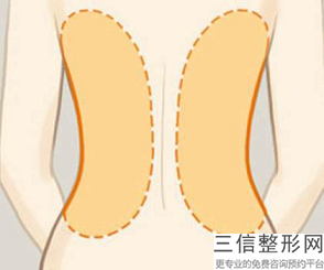 溶脂針減肥瘦身的效果怎么樣