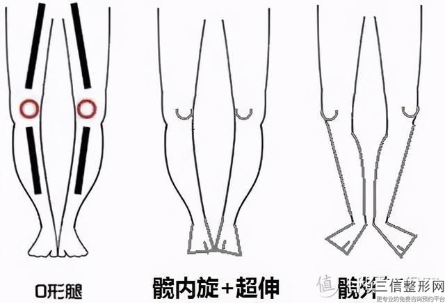 O型腿矯正效果怎么樣