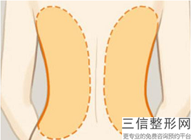 福州激光溶脂多少錢(qián)呢？