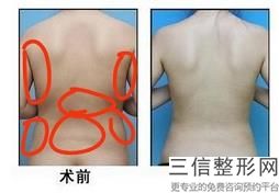 激光吸脂瘦大腿一般多少錢(qián)(激光吸脂瘦大腿大概價(jià)格參考表)