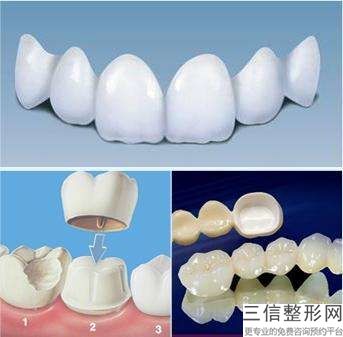 牙齒矯正的費(fèi)用是多少？有哪些因素會(huì)影響正畸價(jià)格