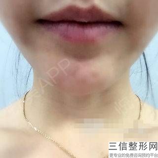 玻尿酸修復后嘴唇會感覺真實嗎？透明質酸豐唇