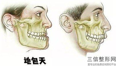 激光祛痘手術利用復色光有效改善我們的面部問題