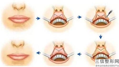 鄭州嘴唇變薄多少錢？讓我們的專家為您詳細介紹