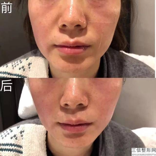 安達的光子美白牙齒會恢復嗎？安達牙齒美白會怎么樣？