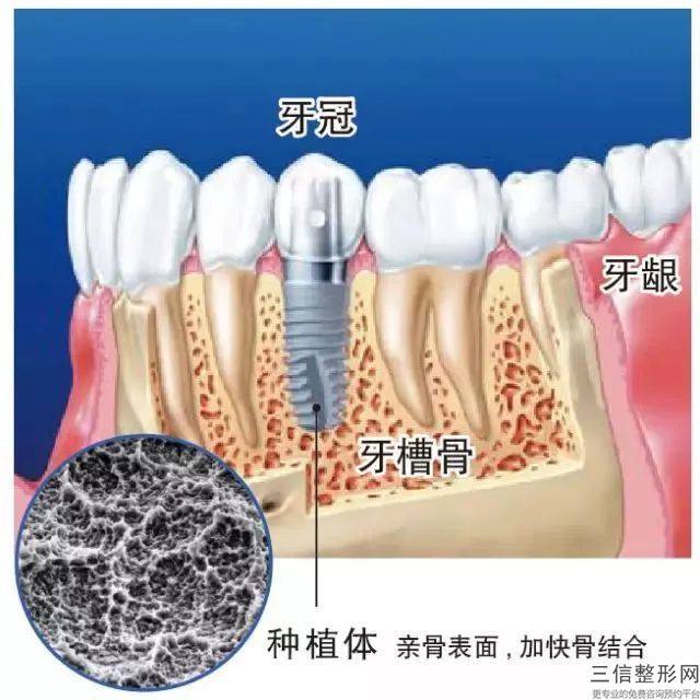 長沙門牙做瓷牙要多少錢？瓷器修復(fù)的因素