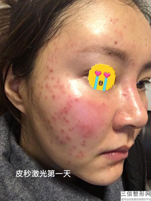 妊娠紋激光手術后如何恢復？激光治療后效果相當不錯