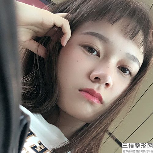 沈陽杏林整形美容醫院怎么樣(周揚青雙眼皮修復)推薦