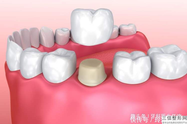 牙缺損金屬烤瓷修復多少錢,牙缺損金屬烤瓷修復術如何調理