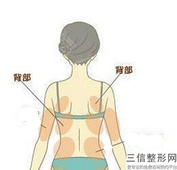 副乳吸脂多少錢,抽脂去副乳，一般多少錢