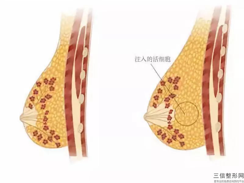 胸部做注射隆胸的效果受什么影響