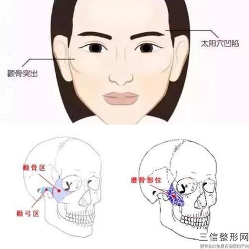 面部輪廓整形到底有沒有效果