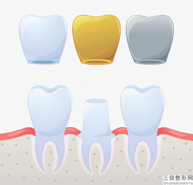 貴金屬牙全瓷牙口腔情況類似手術費會一模一樣嗎