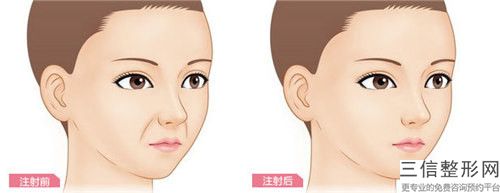 廣元市自體脂肪去法令紋排行榜8強五強-三強資料大總結-排名靠前廣元市整形醫(yī)院