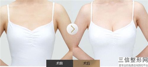 新鄉市乳房上提整形醫院排名TOP10匯總在這里(新鄉亞星智美醫療美容門診部口碑不賴)