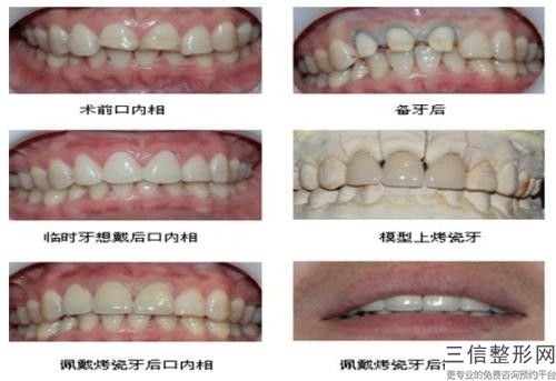 陽泉市冷光美白牙齒醫院前10名強榜技術怎么樣（陽泉市冷光美白牙齒口腔醫院實力不俗）