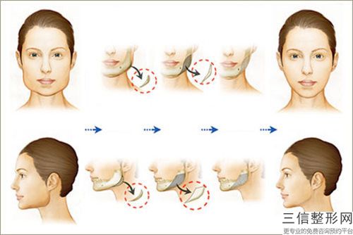 衡陽市環(huán)吸抽脂雙下巴大致價位-衡陽市環(huán)吸抽脂雙下巴均價為3575元