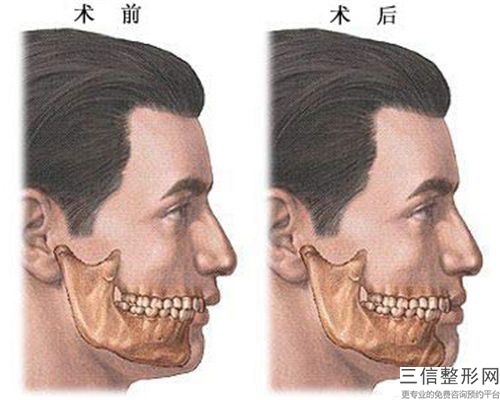 安法硅膠墊下巴整形之后需要怎么護(hù)理