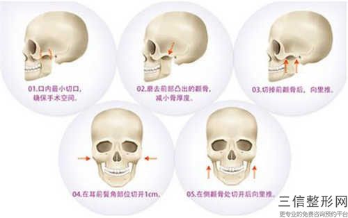 江門顴骨整形術整形手術價格多少