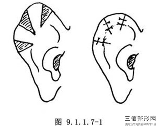 安慶市耳廓形態(tài)畸形無創(chuàng)矯正技術(shù)整形項目價格表一覽-均價耳廓形態(tài)畸形無創(chuàng)矯正技術(shù)27667元