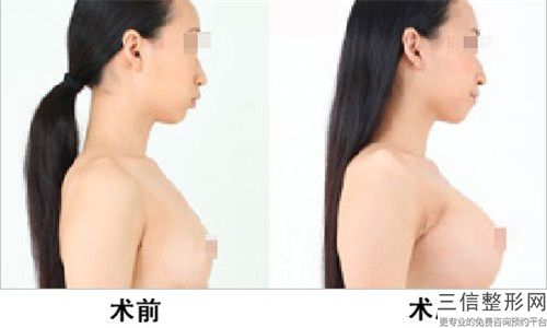 廈門市乳頭乳暈漂紅醫院排名榜十強盤點一下-廈門市乳頭乳暈漂紅整形醫院