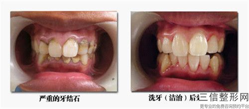 宿州市牙齒拋光術口腔外科價格表手術費用2023版在線查看-宿州市牙齒拋光術價格