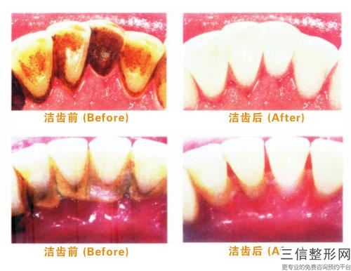 安徽省全瓷牙冠收費(fèi)性?xún)r(jià)比公布-安徽省全瓷牙冠價(jià)格