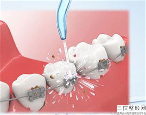 江門氫氧化鈣補牙術價格需多少錢