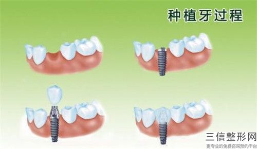 玉溪下門(mén)牙牙齦萎縮大概價(jià)格是多少