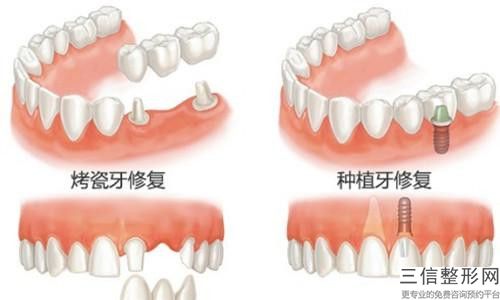 北海上門牙凸出矯正大概什么價位