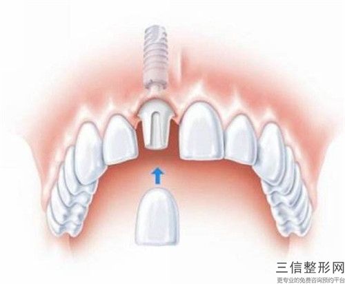 萍鄉(xiāng)二次根管牙冠費用是多少與哪些因素有關(guān)