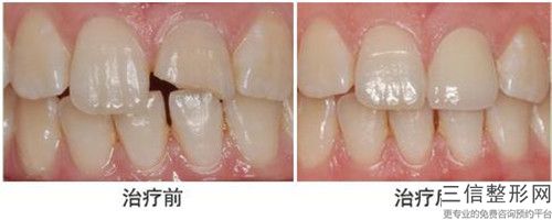 遂寧牙齒牙髓治療整形費(fèi)用貴不貴