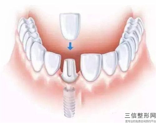 國(guó)內(nèi)矯正牙齒反合的醫(yī)院：矯正牙齒反合醫(yī)院前50位靠譜推薦