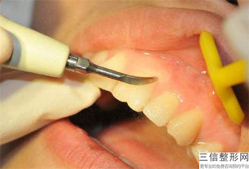 婁底牙齒雕刻手術的費用具體是多少