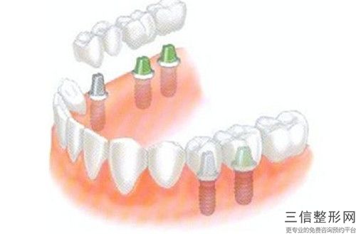 紹興華西種植牙手術(shù)需要的價(jià)格