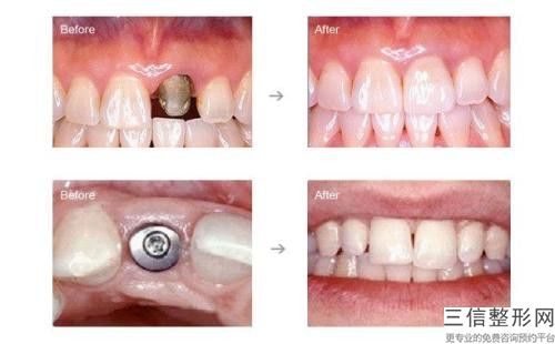 德陽(yáng)北京大慶西格1號(hào)種植牙手術(shù)價(jià)格分析