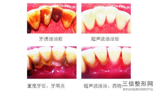 昌吉種植牙齒牙冠手術的后遺癥有什么