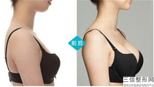 中國乳房整型手術(shù)醫(yī)院推薦：乳房整型手術(shù)醫(yī)院前50良心表更新