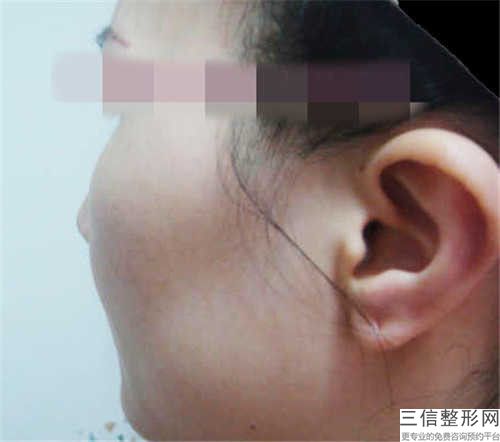 靖江麗人婦科醫院微創整形中心顴骨術案例參考