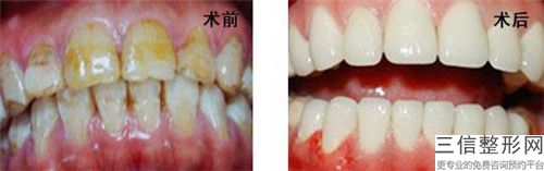 張曉龍潔牙+拋光+噴砂手術(shù)會影響健康嗎