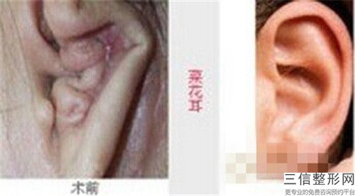 昆明悅玲瓏醫學美容耳朵又小又貼腦術術后護理有什么