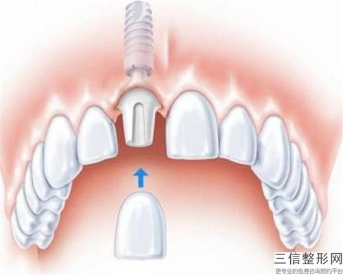 臨汾氧化鋁全瓷牙冠的價(jià)格大概在什么范圍