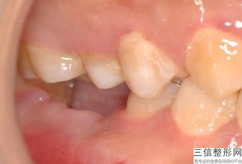 深圳普濟整形美容中心激光修復牙手術方法哪個效果好