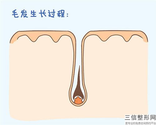 北京第六醫院鬢角處植發整容手術術后護理